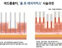골칫거리 여드름흉터, 치료법은?