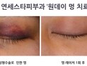 하루 만에 ‘멍’ 없애는 법은?