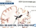 [쿠키건강뉴스] “60세 이상 여성, 체중 감소 클수록 치매 위험 높아”