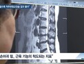 [쿠키건강뉴스] “손아귀 힘 강할수록 척추변형교정술 결과 좋아”