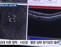 [쿠키건강뉴스] “건성 황반변성 30%, 10년 내 습성으로 진행”