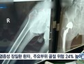[쿠키건강뉴스] “염증성장질환 환자, 척추·고관절 골절 위험 더 높아”