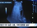 [쿠키건강뉴스] “비알코올성 지방간, 노년기 치매 위험 높여”