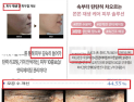 피부재생 된다던 마이크로니들 화장품…알고 보니 ‘부당광고’