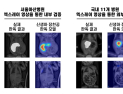 신생아 장천공, AI로 조기 발견…아산병원, 판독 모델 개발