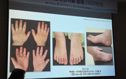 소아 때부터 평생 고생하는 아토피…“과학적 근거 입증 보습제 선택 중요”
